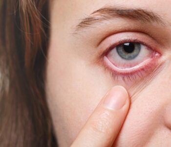 Doenças oculares aumentam cerca de 20% no Verão; conjuntivite é uma das principais ocorrências