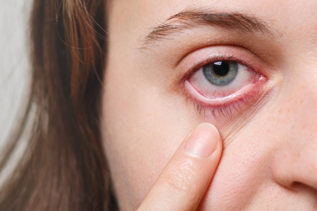 No momento você está vendo Doenças oculares aumentam cerca de 20% no Verão; conjuntivite é uma das principais ocorrências
