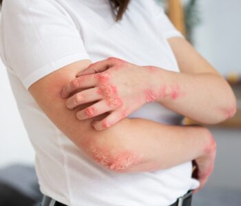 Psoríase: doença de pele não é contagiosa e tem tratamento eficaz, afirma dermatologista