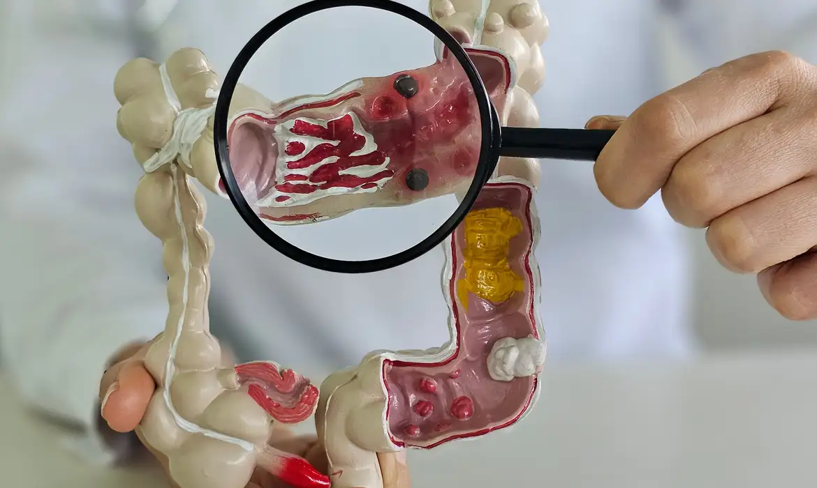 No momento você está vendo Em 13 anos, doença inflamatória intestinal cresce 5 vezes no Brasil